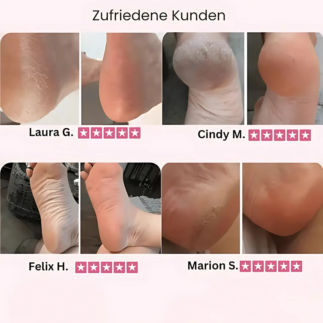 Éliminateur de callosités électrique pour un soin doux des pieds - Image 6