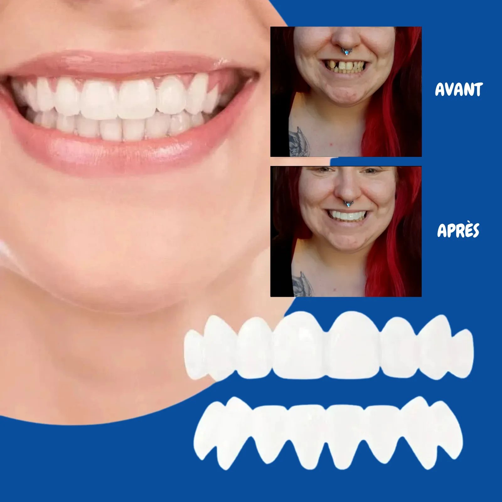 Facettes dentaires souples à clipser – Sourire immédiat - Image 4