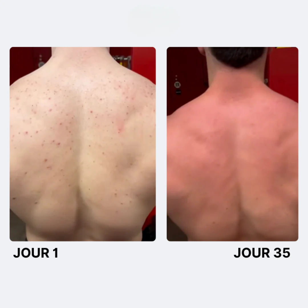Savon Purifiant Anti-Acné - Image 11