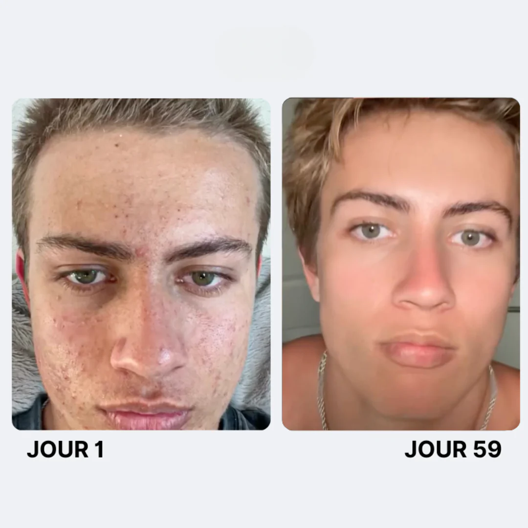 Savon Purifiant Anti-Acné - Image 7