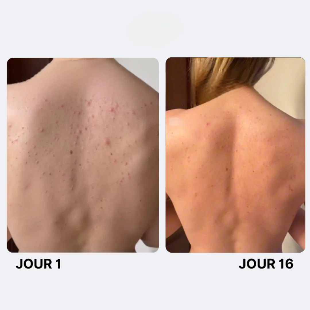 Savon Purifiant Anti-Acné - Image 8