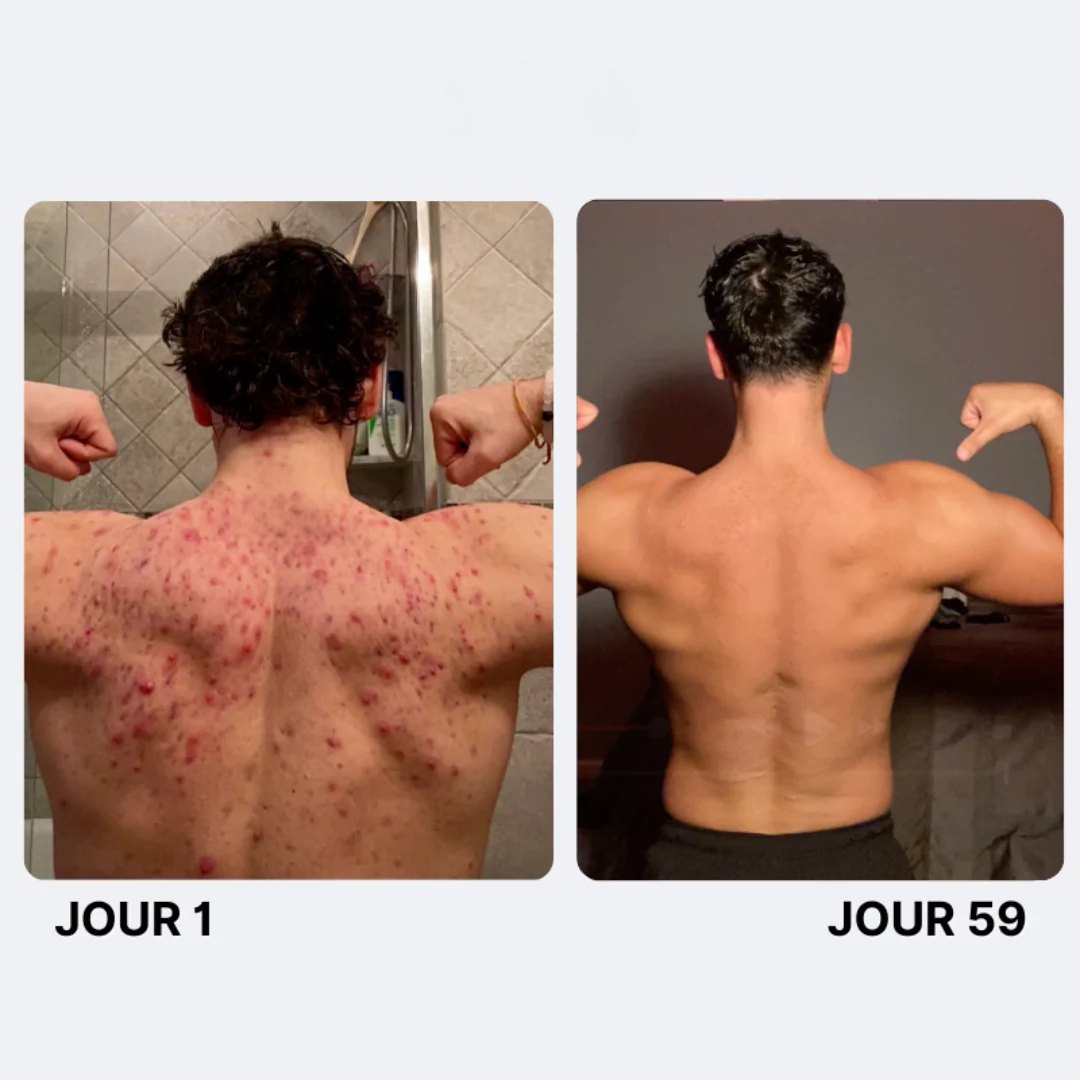 Savon Purifiant Anti-Acné - Image 9